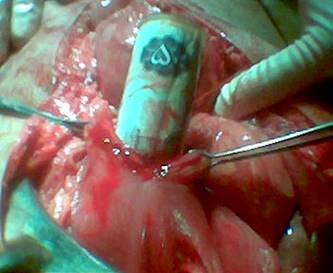 Figure II: Open Stomach with currency note